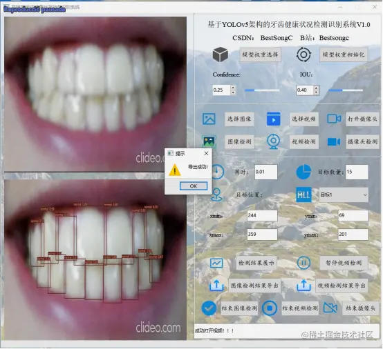 高精度牙齿健康状态检测识别系统2737.png